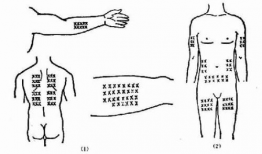 皮下针注射方法视频,视频教程详解